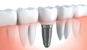 jenkintown-dental-implants-1