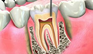 root canal specialist near me